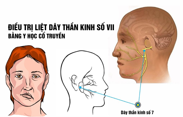 Điều trị bệnh liệt dây thần kinh số VII ngoại biên (bệnh dây thần kinh mặt (Khẩu nhãn oa tà)) bằng Y học cổ truyền